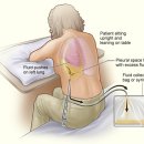 Thoracentesis - 흉곽천자 이미지