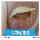 평택 고덕 발톱이 들리고 변형되는 이유, 발톱 박리 관리 사례