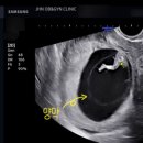 전한나산부인과의원 | [임신] 11주차 초음파, 임신초기 장거리 여행 전 산부인과 방문(전한나 산부인과)