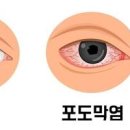 포도막염 (맥락막, 모양체, 홍채염) 눈충혈 증상 &amp; 치료 이미지