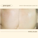 센트럴파크역4번출구 | 인천 송도 피부관리 고은결 플라즈마 화이트닝 색소관리 후기