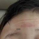 짱2 | 하리짱 두상교정일기 | 2주 정도 후기 | 비바3d헬멧 | 단두증