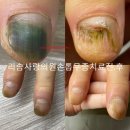 큰사랑의원 | 손톱무좀?피멍 무좀치료 부평 리솜사랑의원 발톱무좀 치료 전문