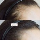 헤어라인 이미지