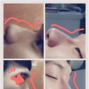교대역피부과 코필러후기!