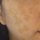 [공지] 환절기 썩은 피부 구조하기 (세예클리닉 리쥬란 포텐자 펌핑팁, 아미스킨 다빼자 솔직후기)