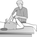 MET treatment of left rectus femoris muscle 이미지