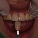 오름치과기공소 | 예쁘게 치료하기 어려운건 앞니 1개짜리 통지르코니아 싱글 크라운, 색맞추기도 어렵고 대칭 모양도 어렵다