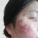 재생한의원 | 리유한의원 내돈내산 심부재생치료 완치&amp;유지 후기