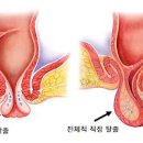 직장탈출증 후 재발 예방 관리법 이미지