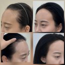 건대 헤어라인 후기 전해드려요｜출산 후 비어 보이던 M자라인 자연스럽게 채운 이야기