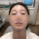 오오피부과의원 | 깊숙히 굳은 피지압출/ 여드름 색소침착 붉은기 치료 /🤑내돈내산 피부과 시술 후기(치료 ing) #신촌피부과