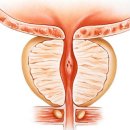 전립선 특이항원 [Prostate specific antigen] 이미지