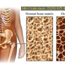 골다공증 퇴행성 신경통 뼈골아픈데 치료와 예방에 좋은 민간요법 이미지