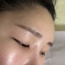 이마필러후기(벨로테로)연신내메이퓨어의원 주름보톡스후기