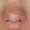 코입