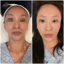 제일한방메디칼 | 청담동 피부과 스킨부스터 리쥬비엘 물광주사 솔직 후기 여름 끝 피부 보습관리 추천