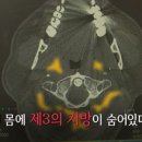 숨어있는 지방의 경고, 이소성 지방 [생로병사의 비밀] 이미지