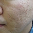 차오름한의원 | 여드름흉터한의원 차오름침 가격 효과 다 만족스러웠던 후기