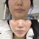 담실 | 부천 피부과 두스실 실리프팅 내돈내산 솔직후기 ( 시술전후 + 부작용 + 효과 + 관리 총정리)