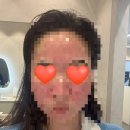 강남밴스의원 | 포텐자 모공팁 후기 | 강남밴스의원(포텐자고통후기)