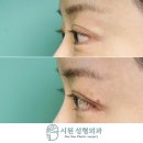 툭임상심리상담원 | 뒤트임 후 발생한 ㄷ자변형과 눈꼬리 처짐 (울상) 을 개선한 3주차 복원 초반 후기 at. 시원성형외과