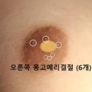 유두 피지 통증 원인 몽고메리결절 예방 이미지