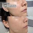 에너지네트웍노동조합 | 잠실피부과 포텐자 쥬베룩 효과 모공&amp;피부결 정돈, 한 달 후기