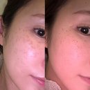 삐삐 | 서울 압구정로데오역 루비레이저 당일 ~ 7일차 후기 (삐삐 탈출 실패!)