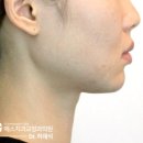 턱관절장애(TMD)와 부정교합 관계_치아교정 후 부작용 발생 원인