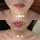 대구 북구 윤곽관리 아르떼 두피탈모센터 칠곡점에서 얼굴 비대칭 관리받아본 찐 후기!