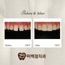 캐드피아치과기공소 | ✨ 치아를 지키면서 예쁘게, 이백점치과 무삭제 라미네이트