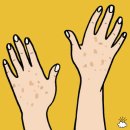 태양반점 이미지