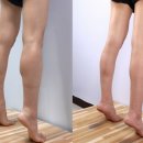 미인의원 - 전주시 완산구 유연로 297 | 감춘 종아리성형의 진실: 마케팅 착시를 넘어선 과학적 해법 - 세이지의원 쫑알주사 후기로 본 효과적 관리
