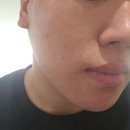 부산의원 | 서면 바노바기의원 부산 리쥬란힐러 1주일 솔직후기