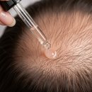 새독일약국 | 미녹시딜 바르면 머리카락이 더 빠질까? 탈모 쉐딩 현상 극복하는 법과 올바른 사용법