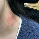 개화약국 | 개화역 습진 피부과 전문의 다녀온 후기!