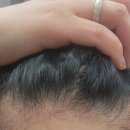 멍발머리 | 광주광역시모발이식 내돈내산후기 여자엠자모발이식매직하기