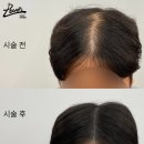 레이븐스칼프