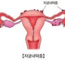 자궁 내막증과 선근증 증상 수술 임신 가능할까? 이미지