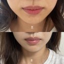 중동한의원 | 부산 해운대중동피부과 티타늄 대신 이중턱, 땅콩형얼굴울쎄라 300샷 내돈내산후기