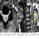 목 디스크의 증상 이미지