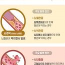 뇌졸증 전조 초기증상 뇌경색 뇌출혈 차이 예방 관리 이미지