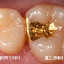 남산치과기공소 네이버블로그