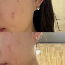 현한의원 | 강남역 한의원 여드름흉터 색소침착 새살침 치료 후기 3회차