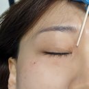 프레야안경 | 대구 비립종제거, 프레야뷰티, 수성구 비립종제거