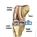 십자가축병원 | 십자인대 파열 후 산재로 십자인대 재건술 한 환자...후기-정형외과 관절내시경전문 웰튼병원 관절센터