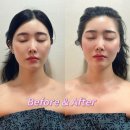 해독 | 붓기 정리 제대로! 왕십리윤곽관리 정율환골윤곽연구소 해독윤곽 후기