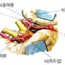 뇌동맥류 이미지