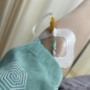 다형 | 이하선 종양(다형선종) 치료 후기 - 2. 수술
